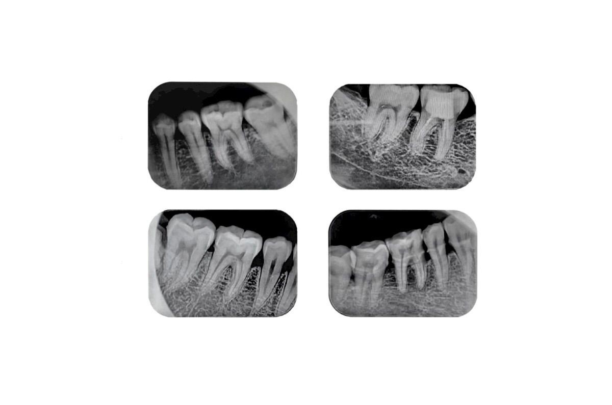 Four dental X-ray images showing teeth and roots in different sections of the mouth.